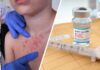 Measles Outbreak Takes Deadly Turn as Pennsylvania Reports First U.S. Deaths