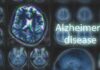 Carer Stole £25K From Elderly Couple With Dementia Brain MRI scans with highlighted section and text overlay